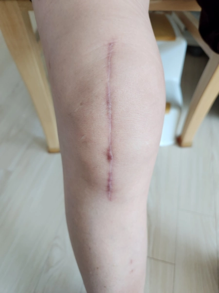 무릎 수술  부위 (5개월)